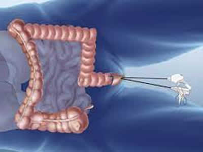 Cirugía de Colón  Riobamba